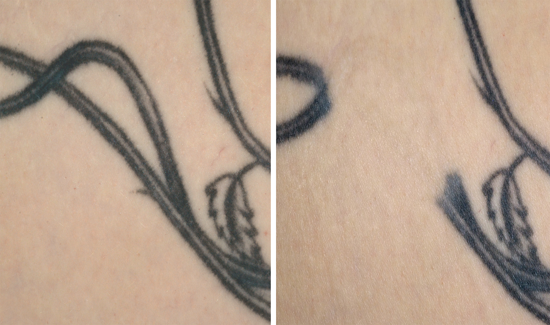 Soliton, Inc.: Study Shows New Acoustic Shockwave Technology Can Make Tattoo  Removal up to 3 or More Times Faster Than Using Traditional Laser